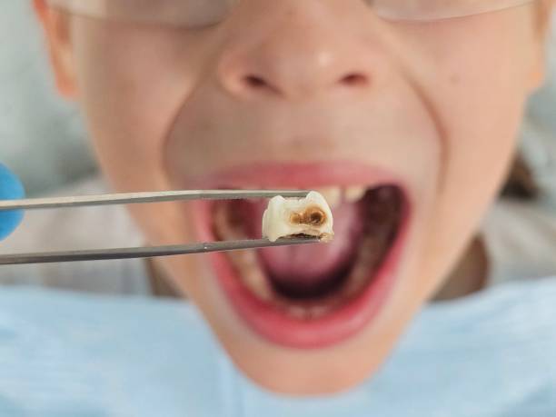 Best Emergency Dentist for Lost Fillings or Crowns in Hickory Creek, TX